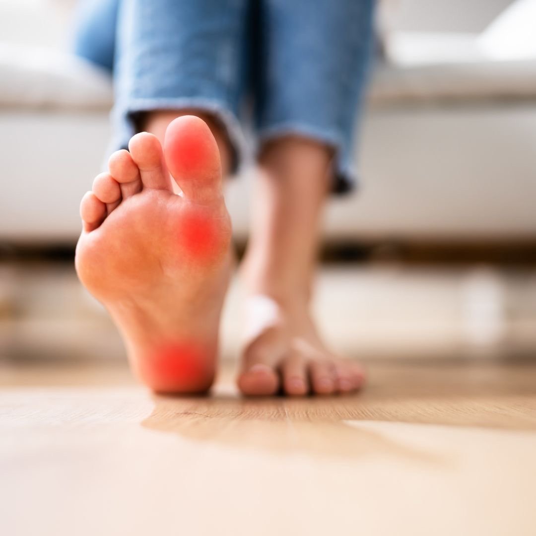 Close-up of a person's foot with red irritated areas on the heel and toes.