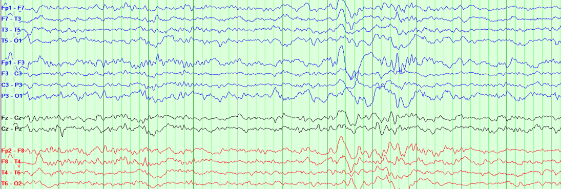Electroencephalogram (EEG) recording with multiple brain wave channels in different colors, including blue, green, black, and red, showing brain activity patterns.