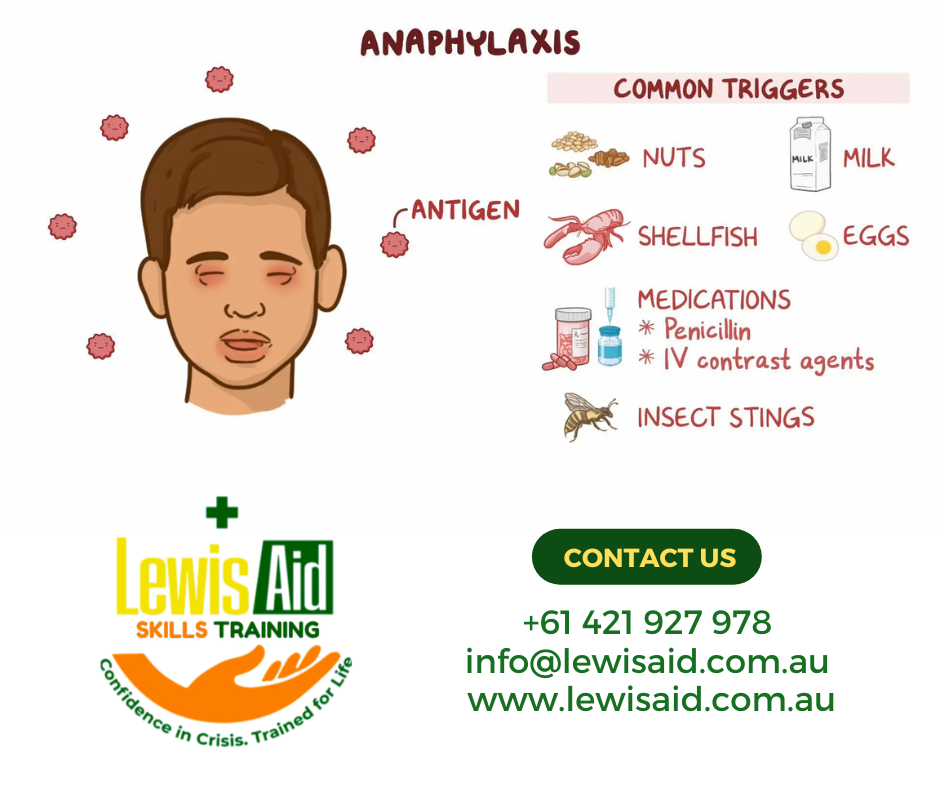 Could You Spot the Signs of a Life-Threatening Allergic Reaction?