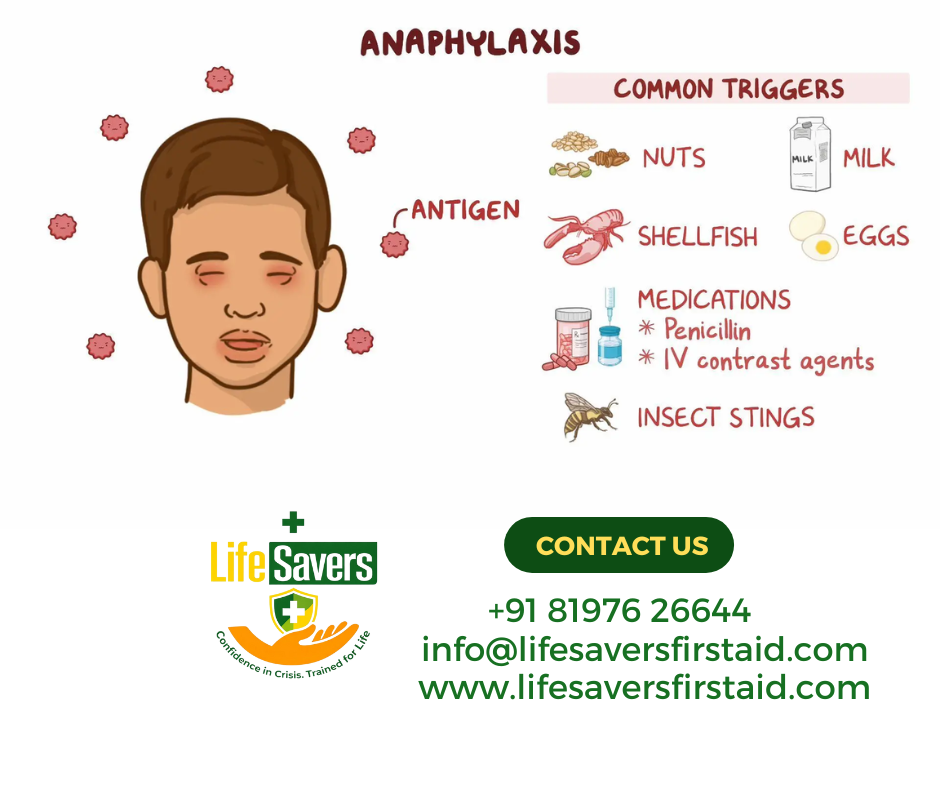Could You Spot the Signs of a Life-Threatening Allergic Reaction?