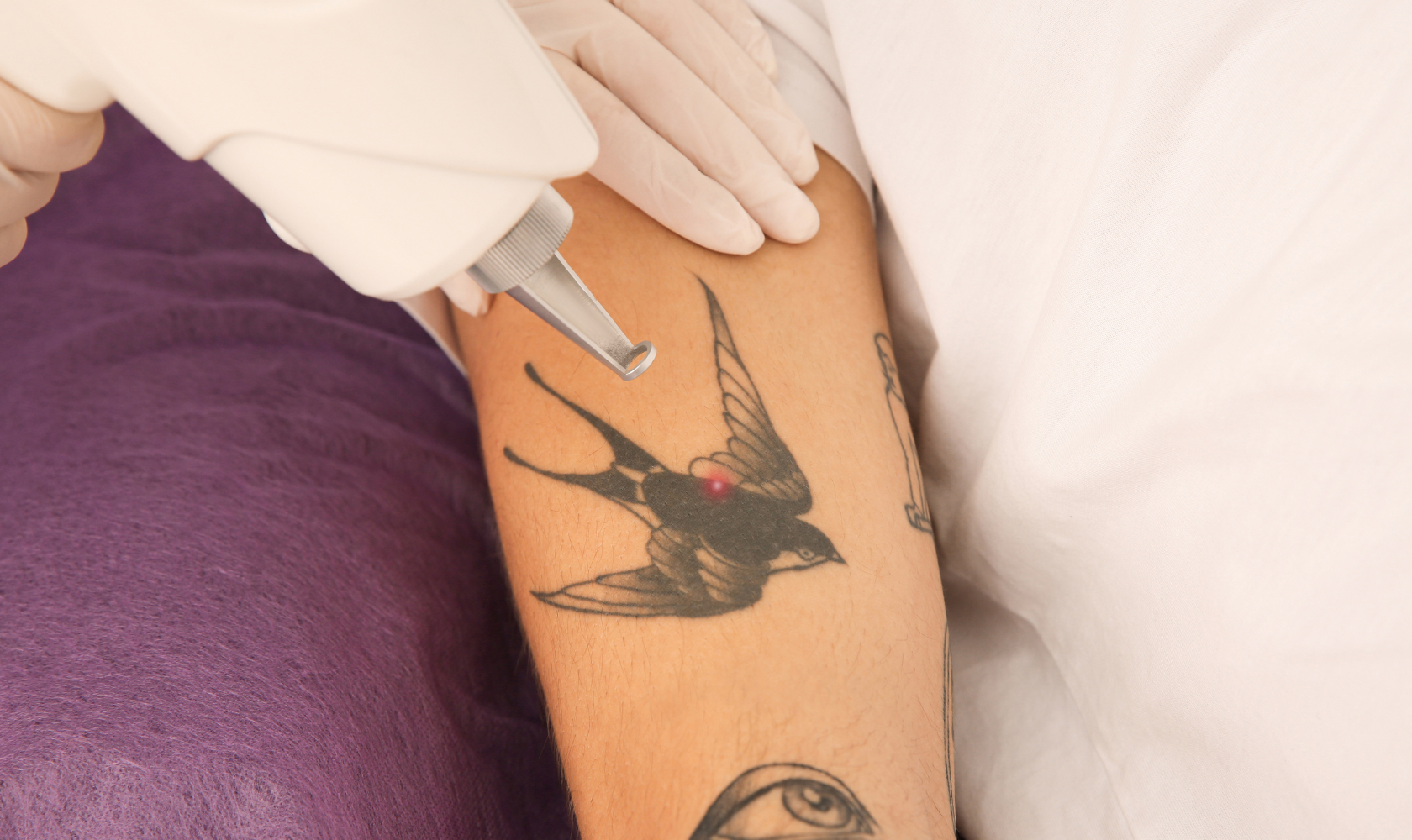 Medspa in Turlock, CA, 95380  Tattoo Removal Near Me.png