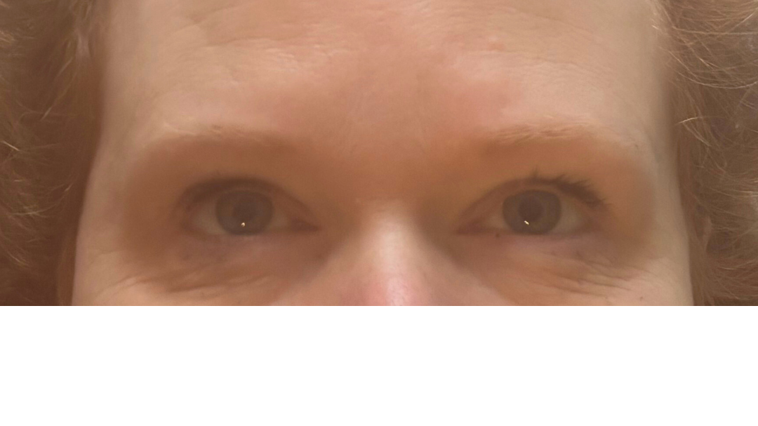 Pre-treatment image showing light, sparse brow hair with limited natural definition. Assessment focused on symmetry, bone structure and skin suitability prior to corrective planning.