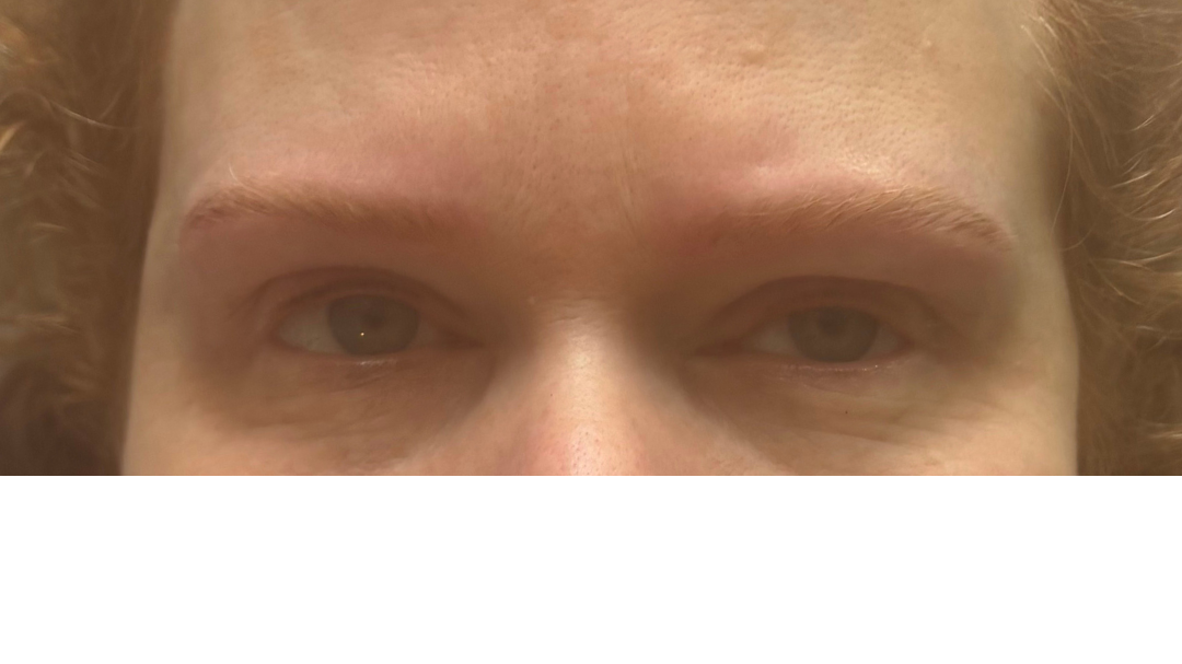 Immediately after first corrective session. Structure and balance have been re-established using a conservative approach, with pigment placement tailored to skin and hair characteristics. Colour will soften during healing, with refinement planned at 