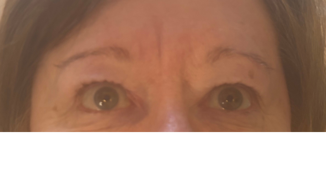 Before treatment: sparse, uneven brows with loss of definition and symmetry, typical of mature skin and natural hair thinning.