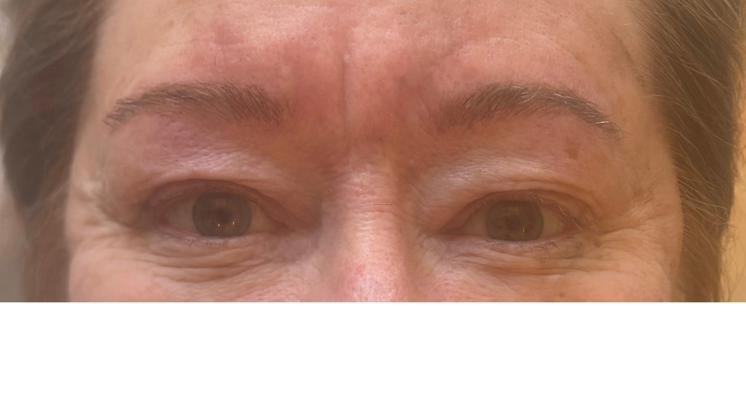 Immediately after first nano brow session: fine, natural hair-like strokes added to restore shape, balance and gentle definition. A refinement top-up is completed after healing (around 6 weeks).