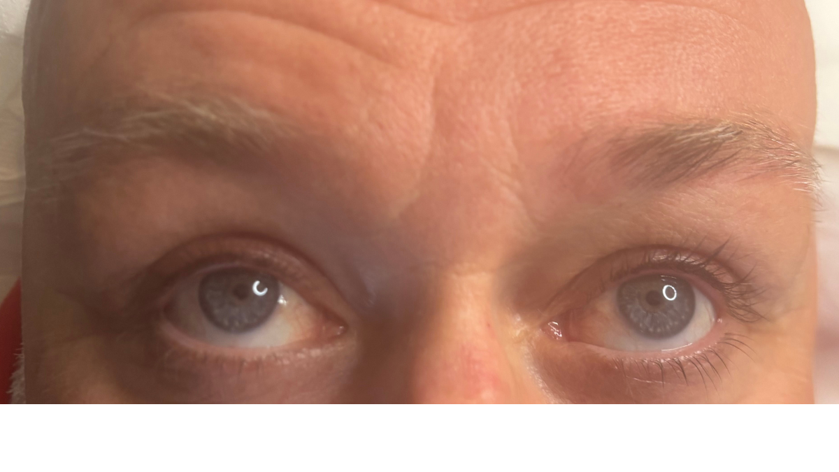 After: Soft, natural restoration, filling gaps and building fullness while maintaining a realistic finish. Immediately after first treatment.