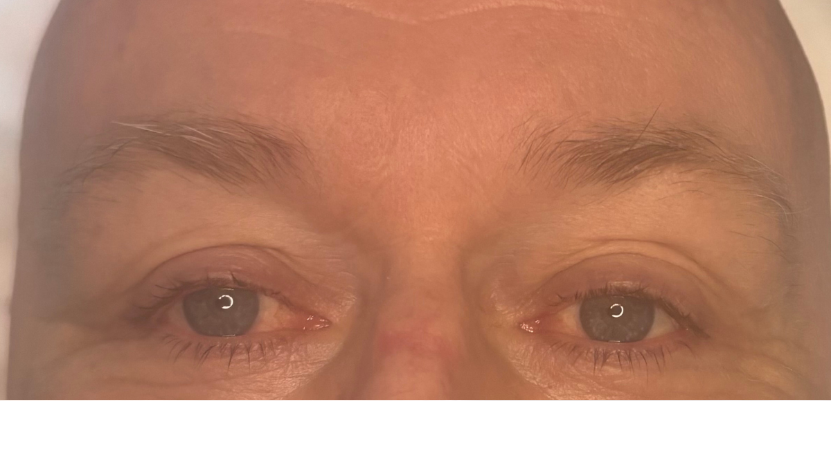 Healed: Thicker, fuller, more shapely brows without any obvious signs of treatment.