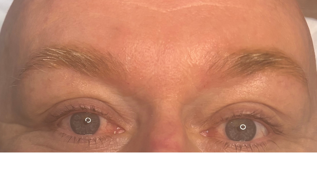Immediately after six week top up. Client wanted deeper enhancement. Colour will fade around 30% as it heals, developing into a fuller, denser brow, whilst maintaining natural appearance.