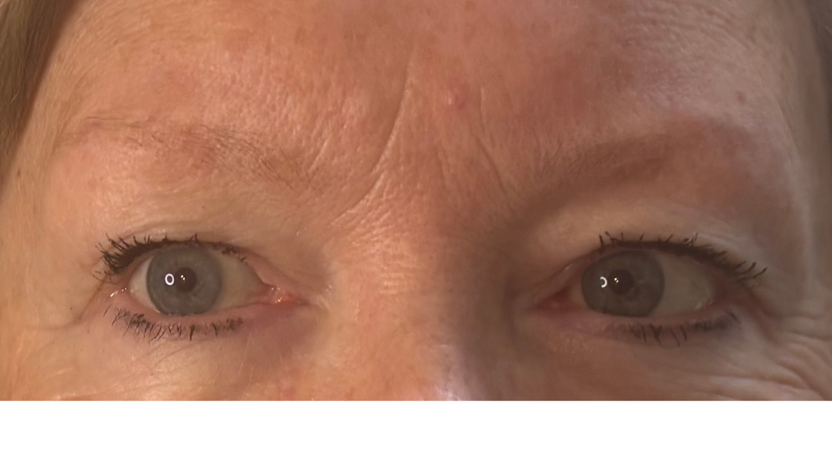 Before natural hair strokes for client with thyroid and cancer treatment related hair loss.
