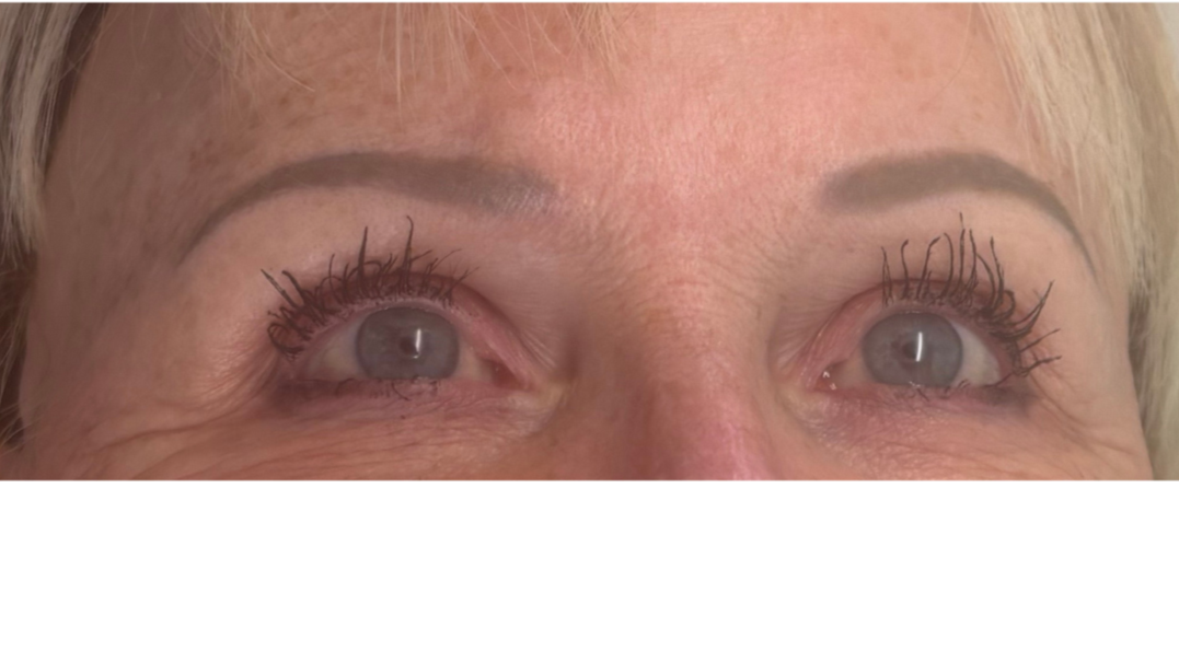 Before natural hairstrokes for alopecia client with previous faded PMU