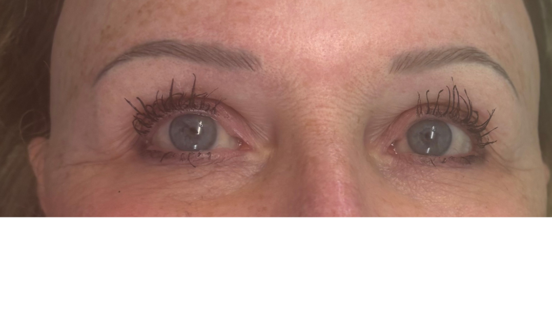 After natural hairstrokes for alopecia client with previous faded PMU
