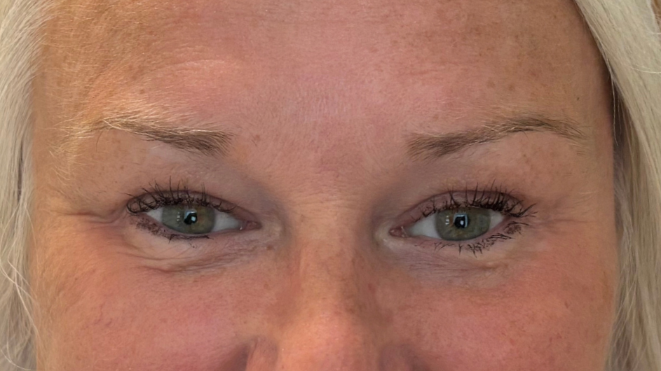 Sparse brows post illness and treatment. 