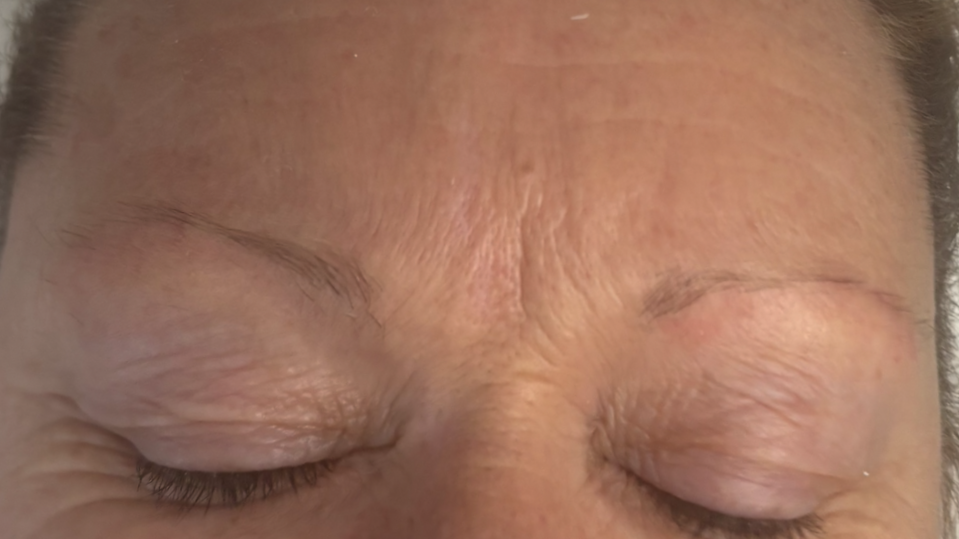 Sparse eyebrows post illness and treatment.