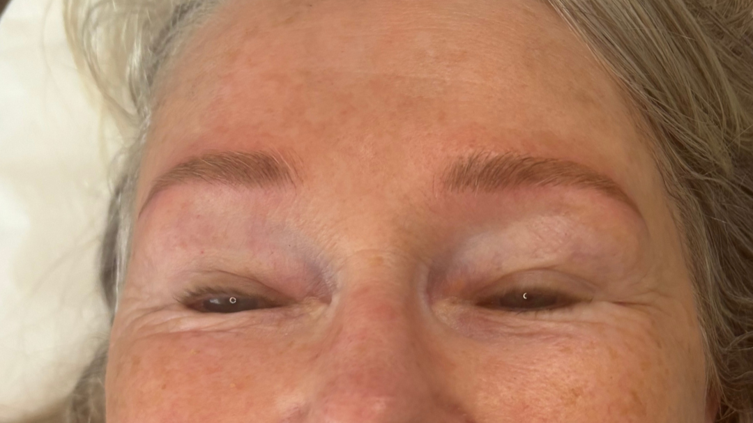 Brow restored with natural colour and shape.