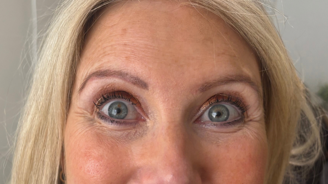 Before treatment. Previous PMU visible with some shape imbalance remaining and colour fading out red.