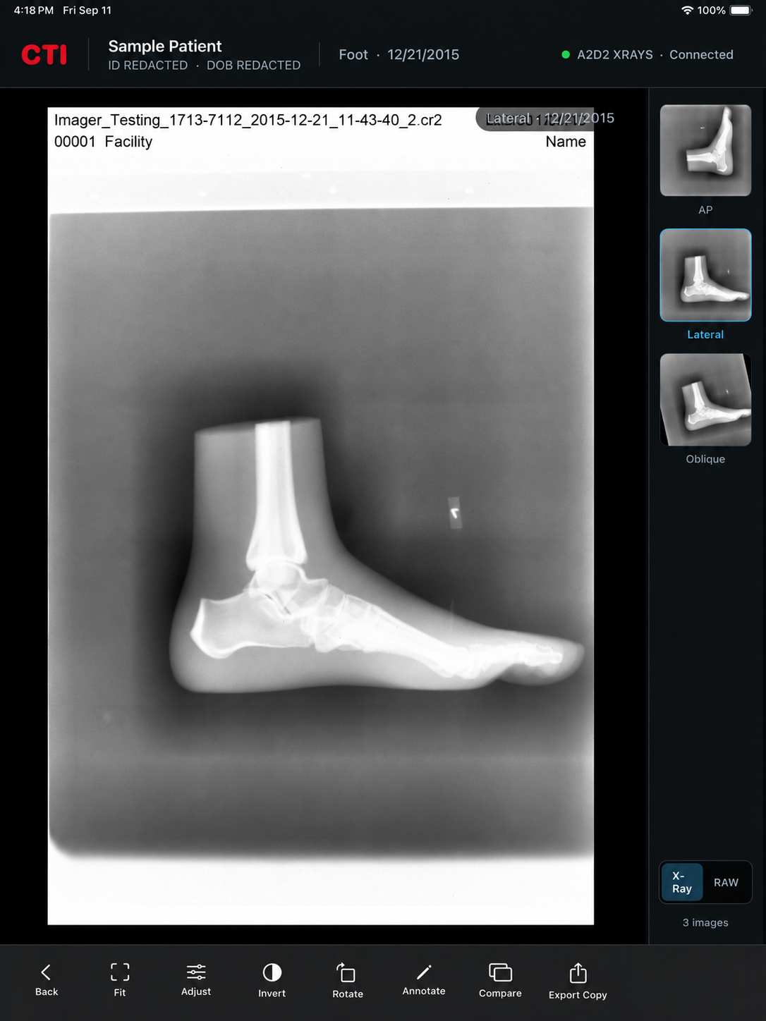 CTI A2D2 X-Ray Viewer displaying a redacted foot X-ray