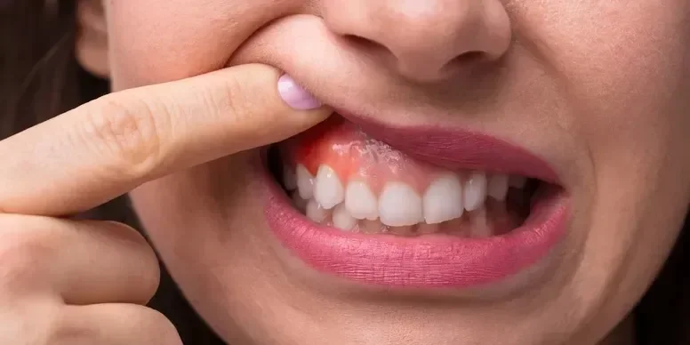 Image of a woman showing bad gums