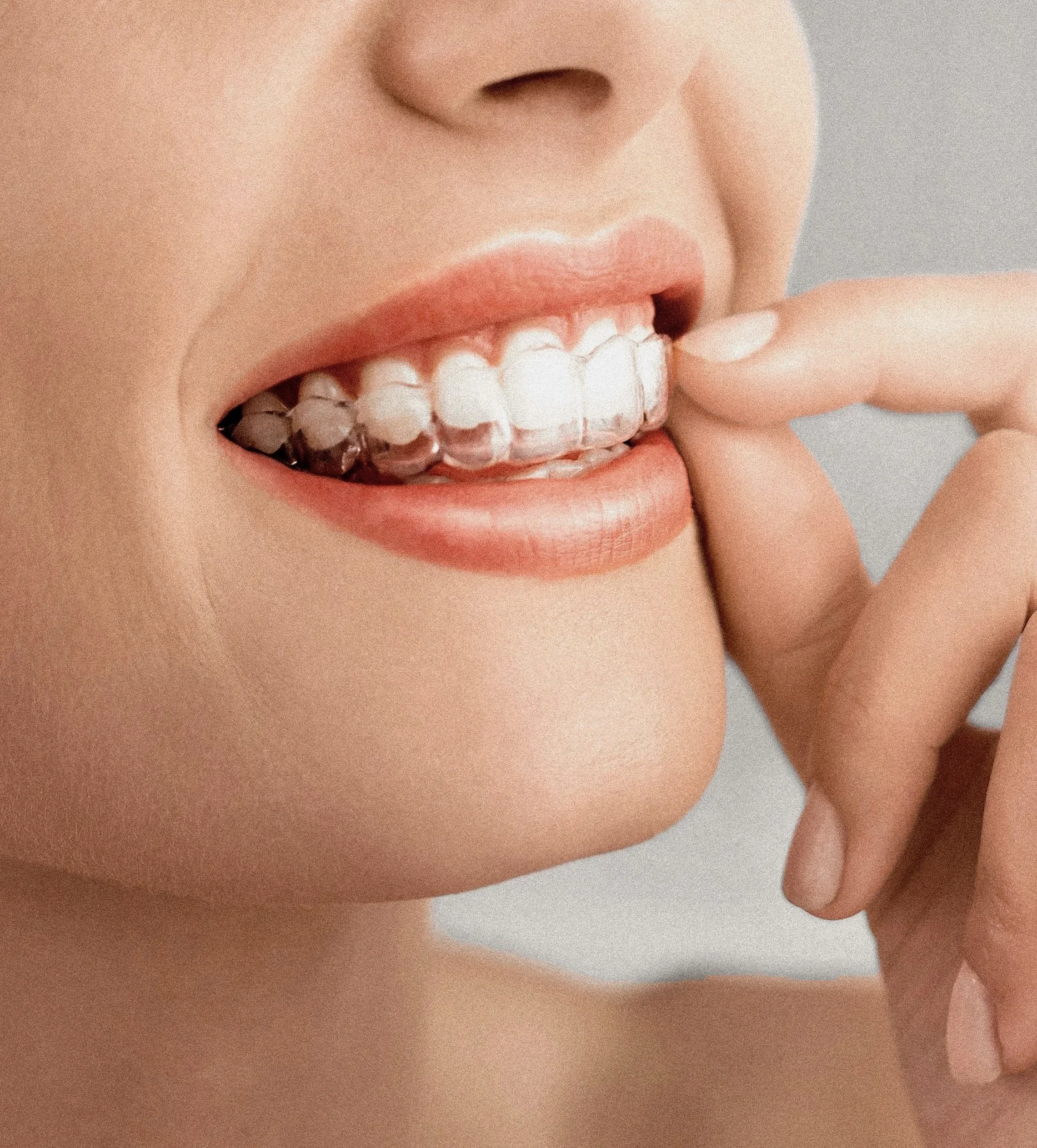 Close-up of a woman with Invisalign Clear Braces