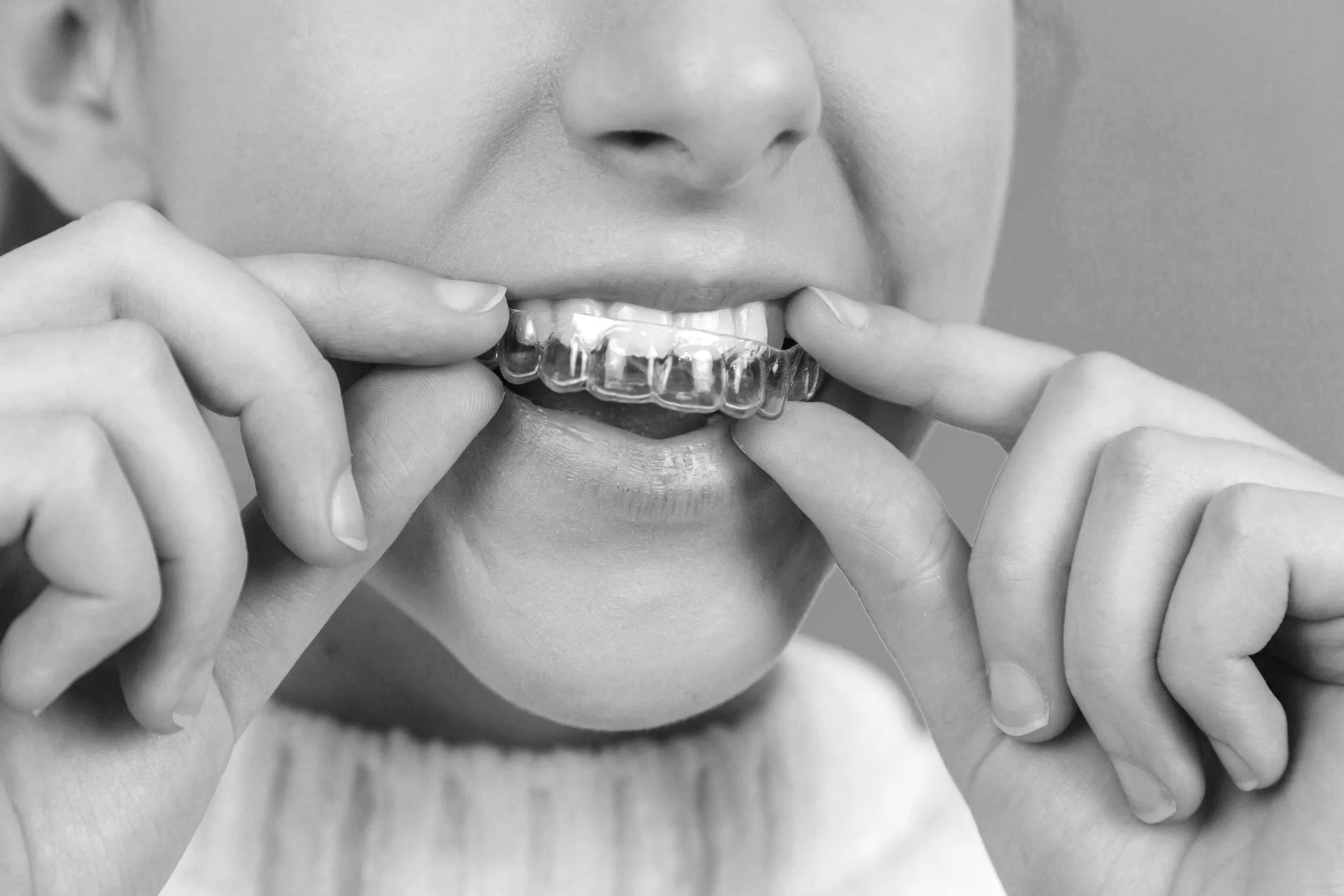 SmileView and Orthodontic Treatment: Helping You Make an Informed Decision