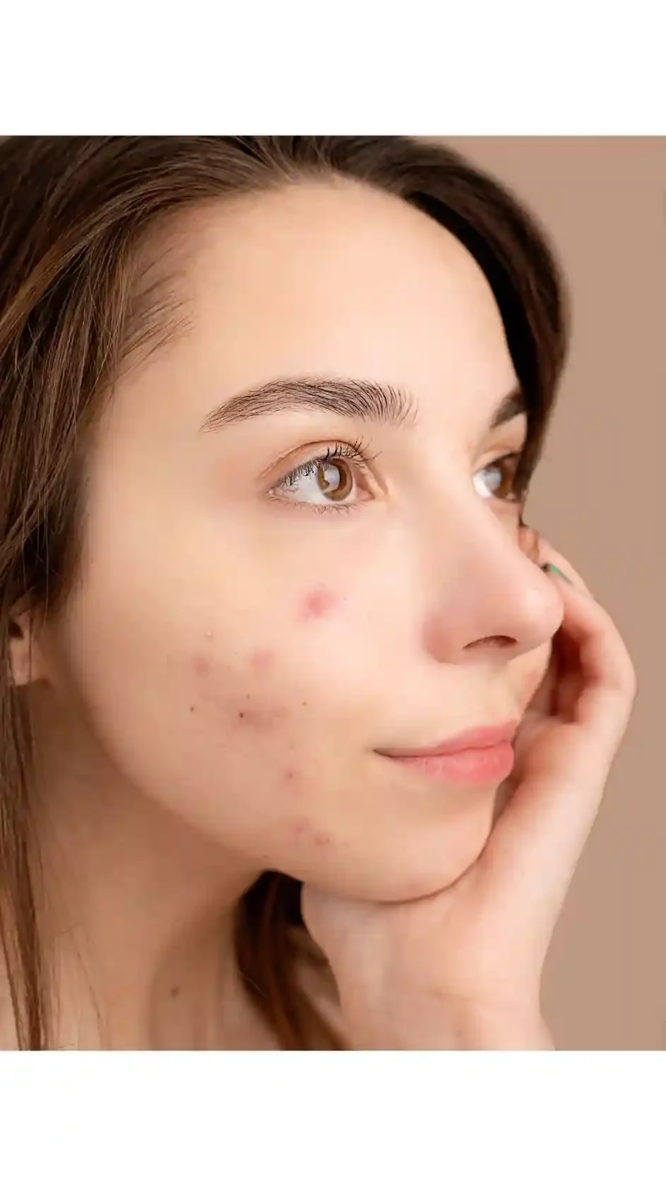 Acne, Rosacea, Blimished and Anti-Aging