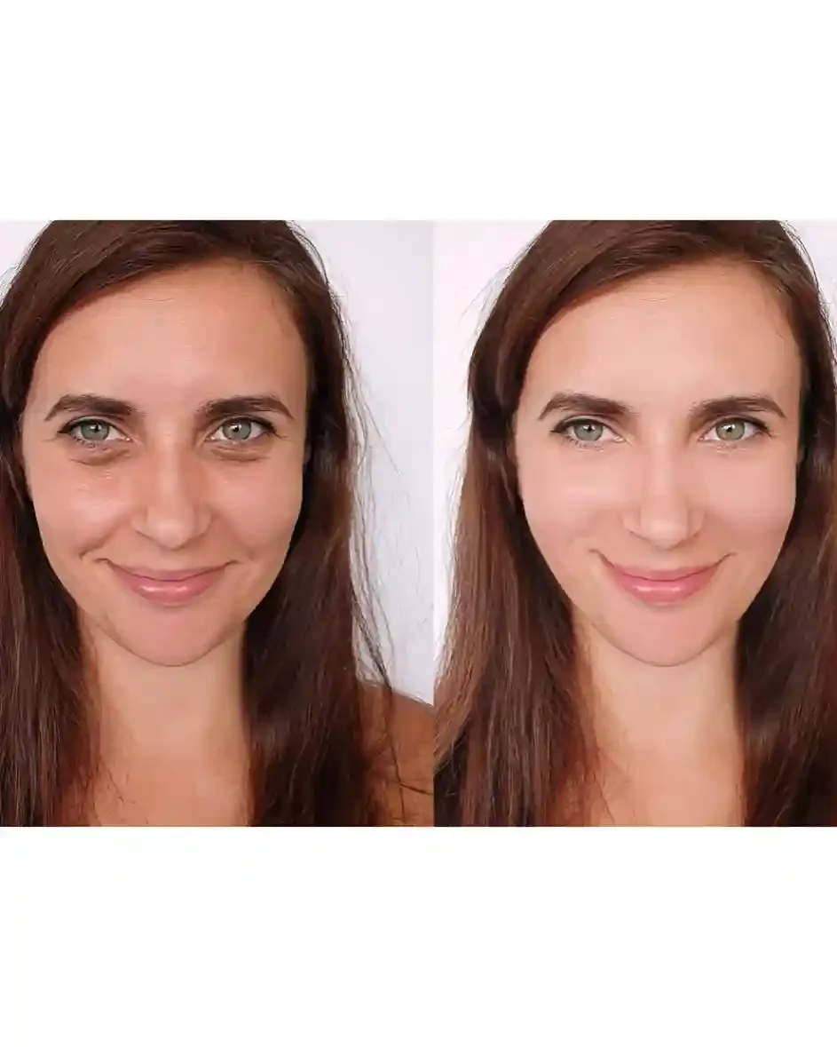 Advanced Care for Acne