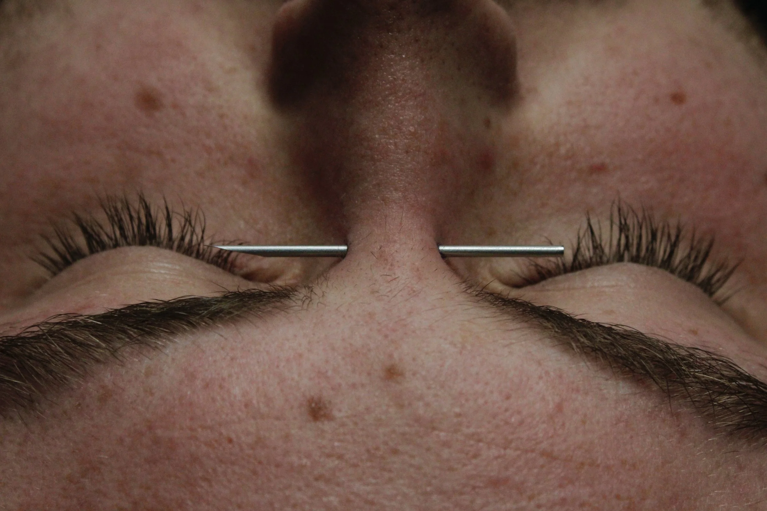 Close-up of a person's face with closed eyes, lying upside down, receiving an acupuncture treatment with thin metal needles inserted into the skin around the nose.