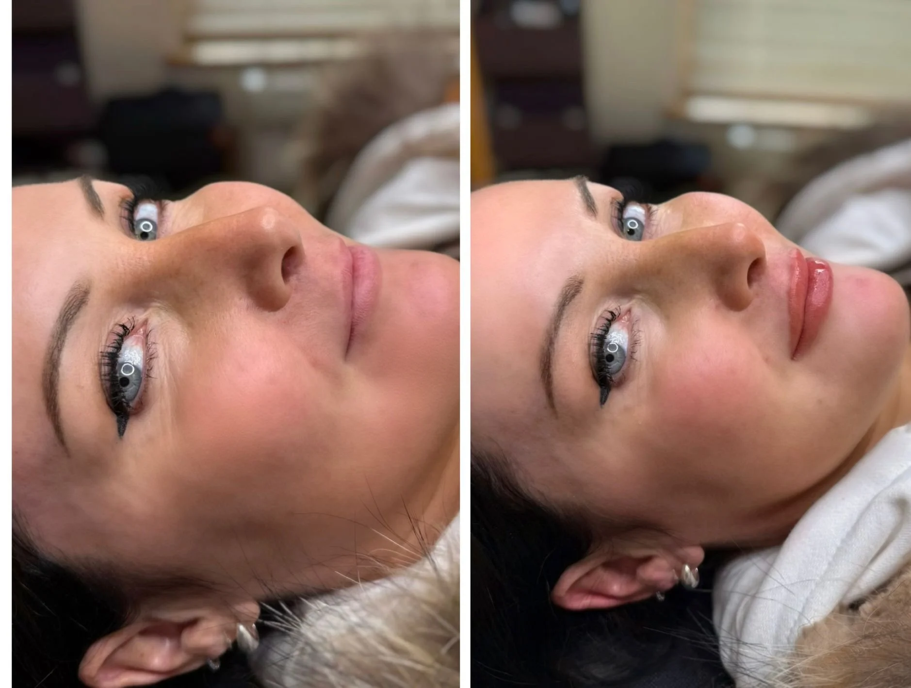 Close-up of a woman's face before and after lip enhancement, showing improved lip fullness and shine.