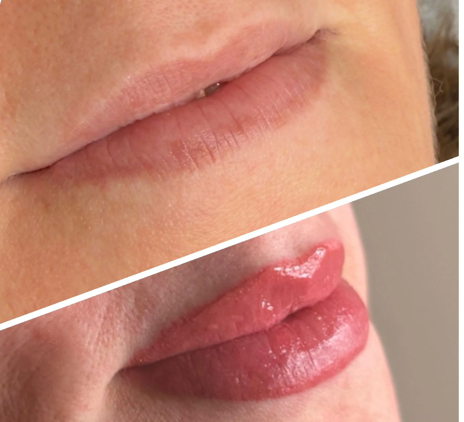 Comparison of lips before and after cosmetic enhancement, showing smooth, natural lips above and fuller, glossy lips below.