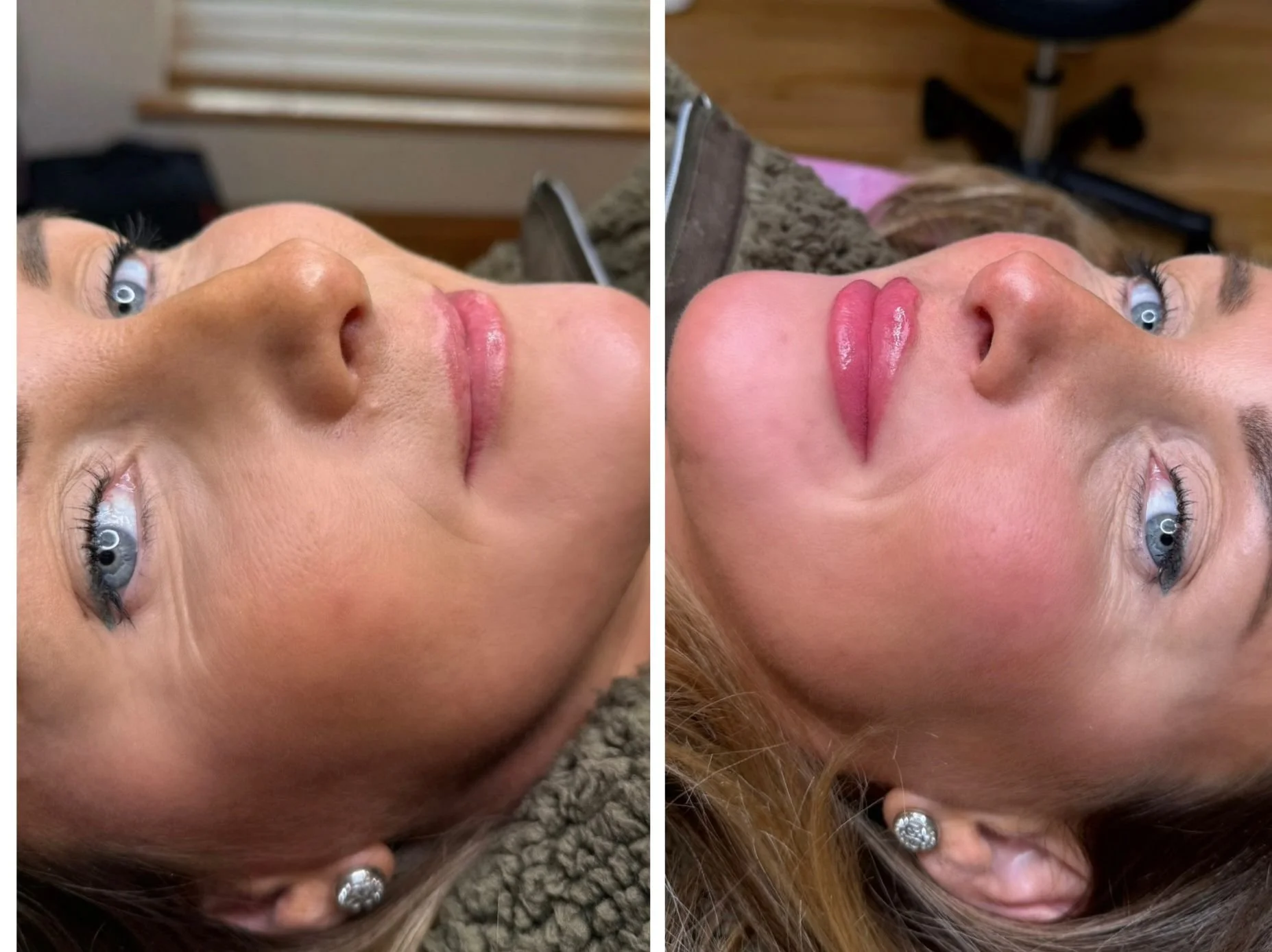 Before and after photos of a woman showing the results of cosmetic lip enhancement, with fuller, plumper lips in the after image.