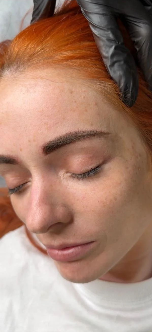 Close-up of a woman with red hair and lightly freckled skin, with her eyes closed, receiving a cosmetic procedure with a gloved hand near her hairline.