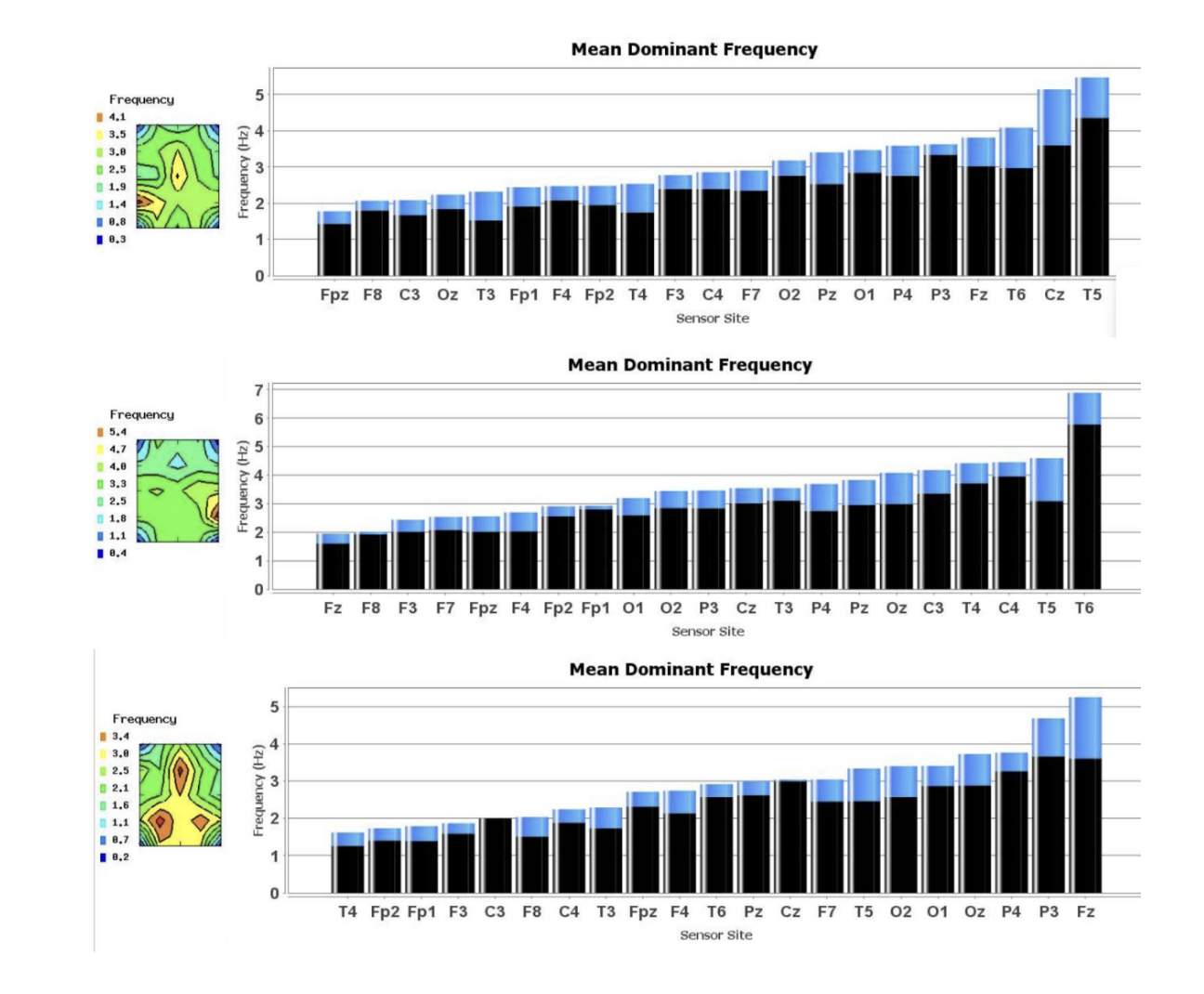 EEG brainwave analysis charts showing mean dominant frequency data across sensor sites, illustrating brain activity mapping used in Regenesis Neuro assessments.