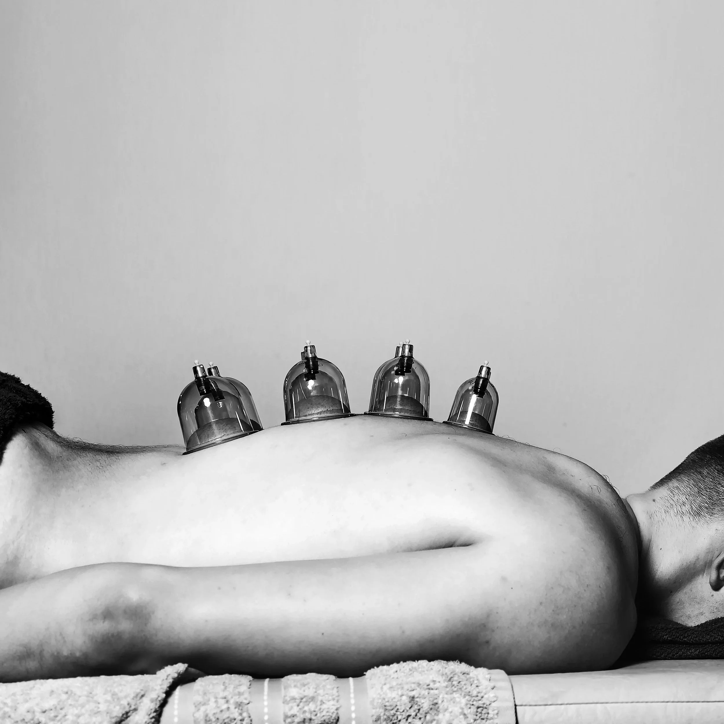 A person lying face down on a massage table with four glass cupping therapy cups on their back.