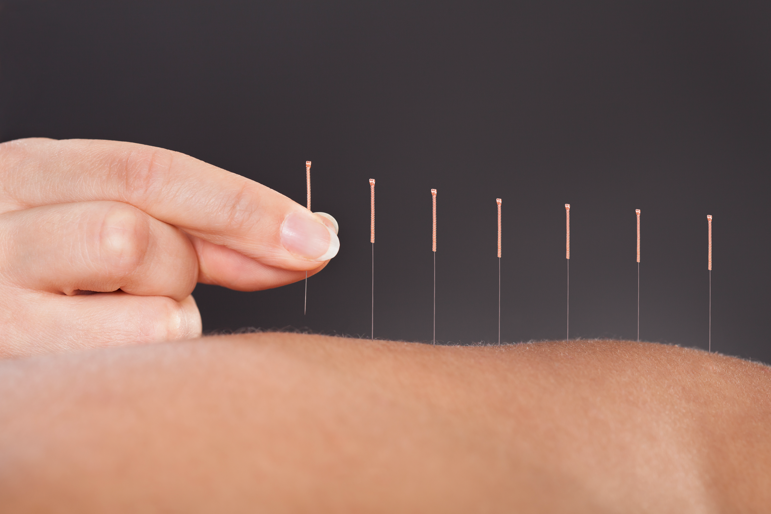 Close-up of a hand with acupuncture needles inserted into a person's back during an acupuncture session.