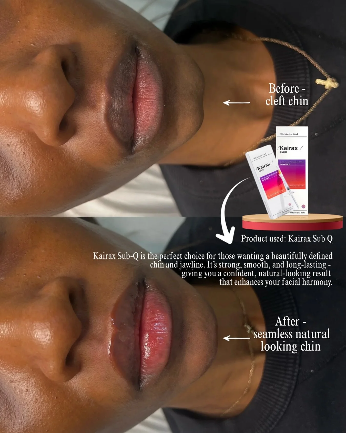 Cleft chin correction made simple 👏🏼
Using Kairax Sub-Q, we&rsquo;ve created a smooth, natural chin profile that beautifully enhances facial balance and confidence.
Results are long-lasting, natural, and perfectly tailored to you.

📍 Book your fac