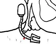 Line drawing of a feeding tube connected to a person's nose, with a small device attached to the tube.