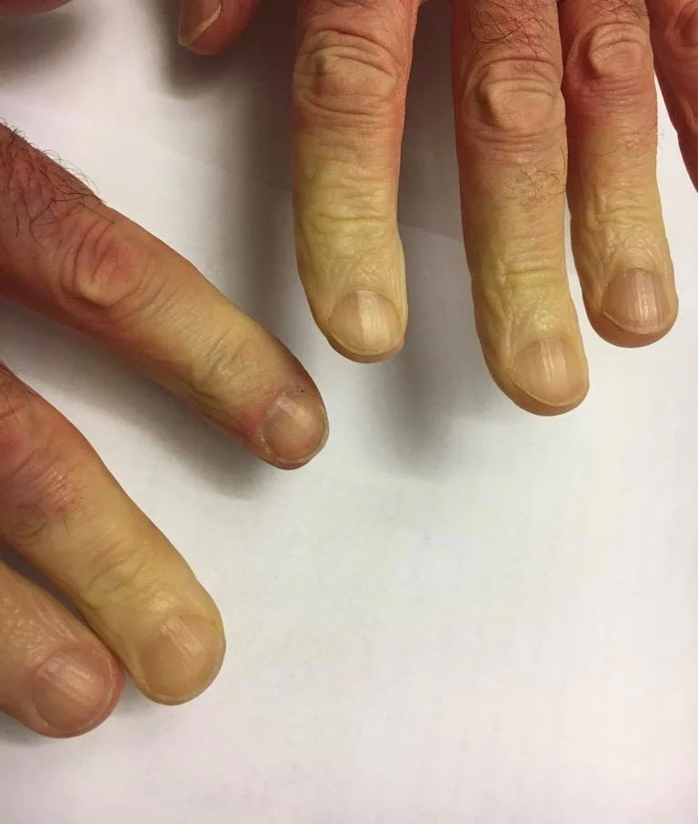Raynaud-Barr-Syndrom