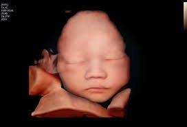 A 3D ultrasound image of a baby’s face.