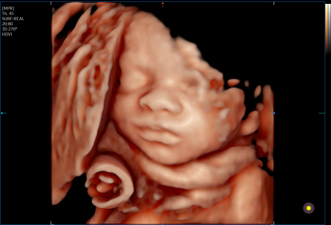 3D ultrasound image of a unborn baby with facial features clearly visible.