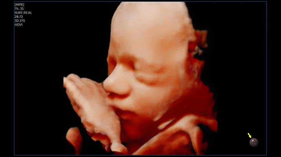 A 3D ultrasound image of a developing fetus with its eyes closed, nose, and mouth visible, holding one hand near face.