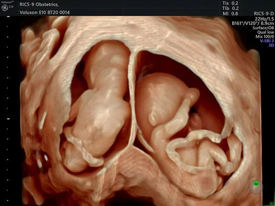 Ultrasound image showing two developing fetuses inside the mother's womb.