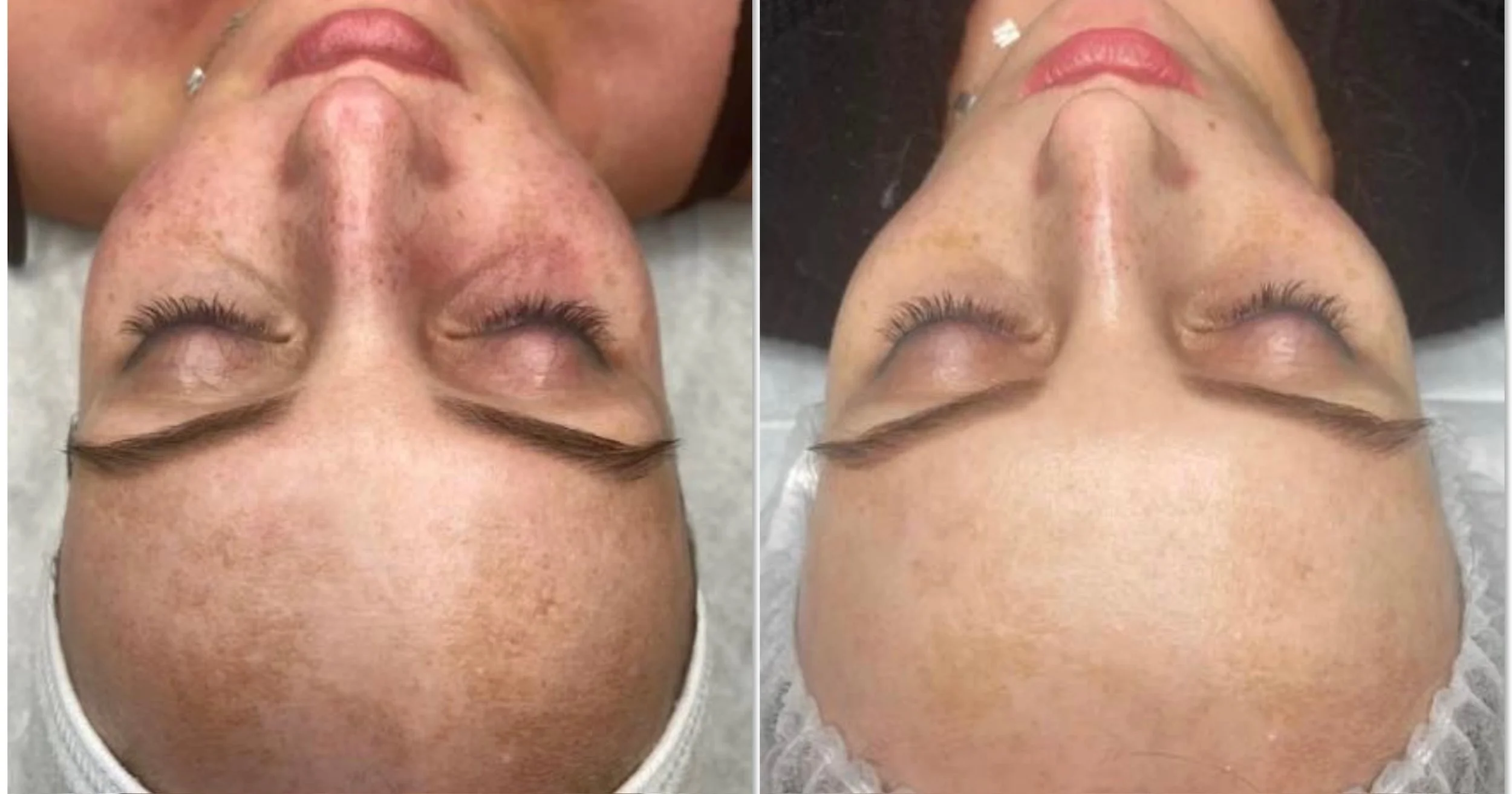 Comparison of a woman's face before and after skincare treatment, showing clearer skin and reduced redness.