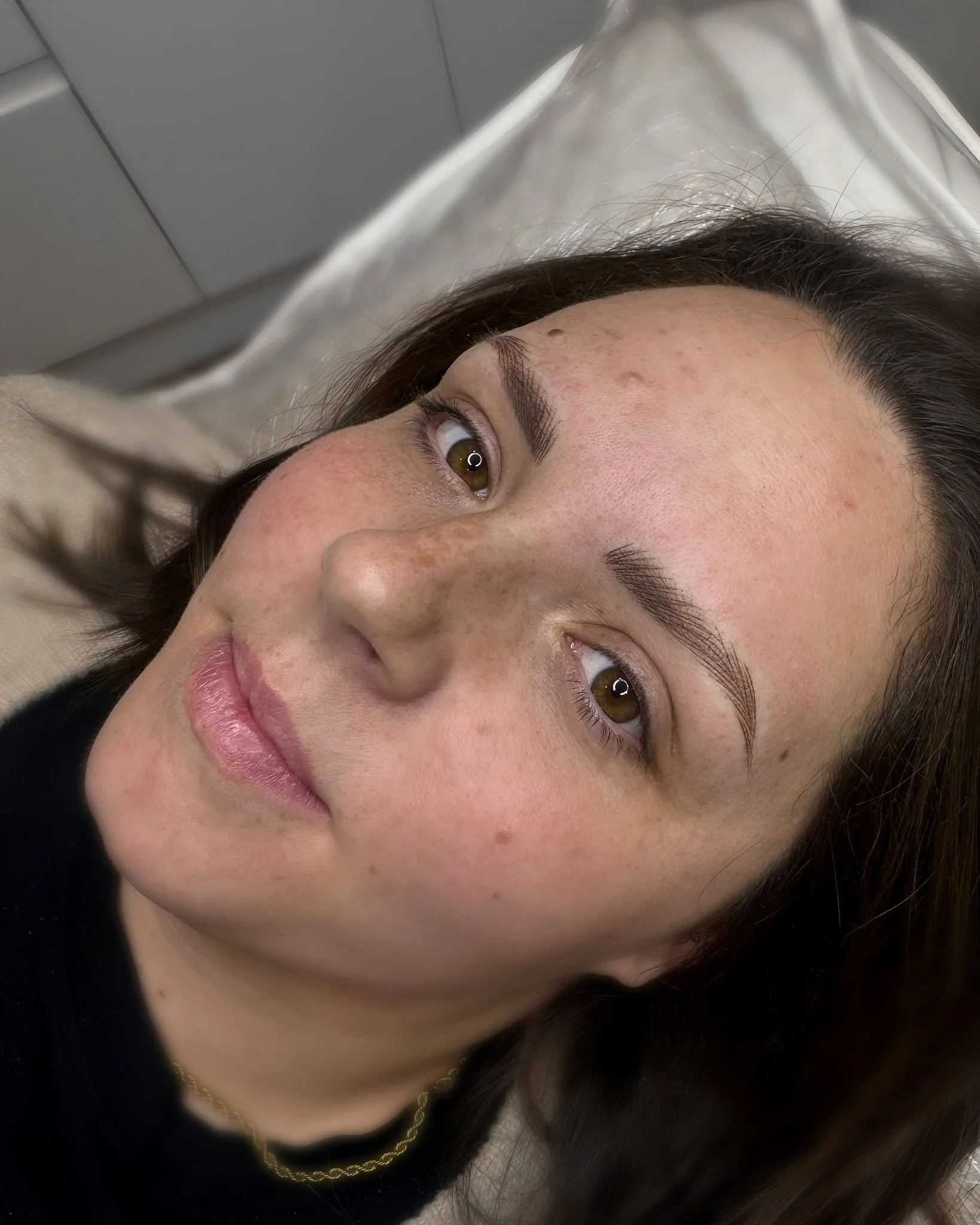 A woman lying on a medical bed with slight freckles and clear skin, looking to the side, with a neutral facial expression.