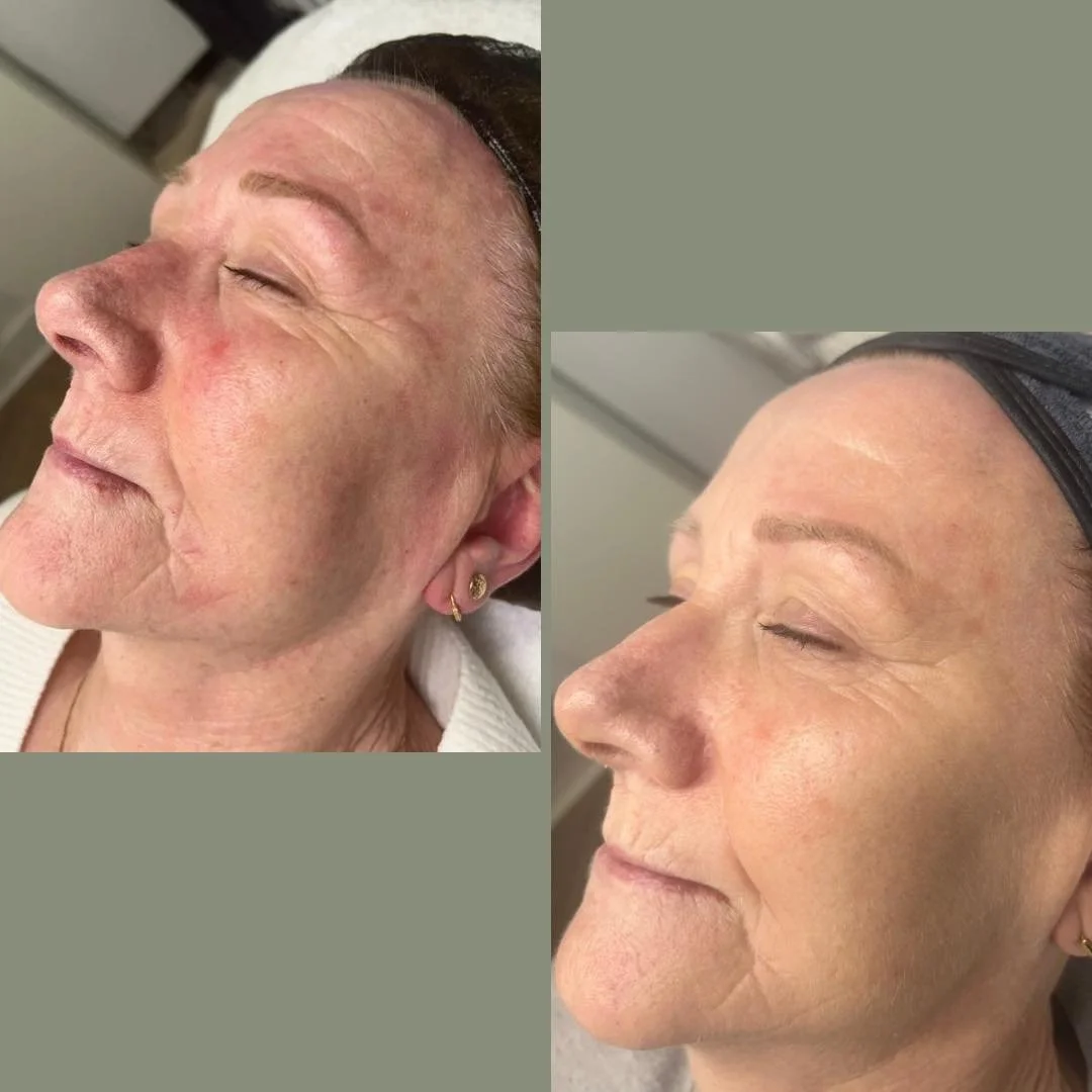 More amazing results with The Dr Platon Cold Plasma Device with Lucy - Beautywith Lucy Robertson

A client recently came to me with concerns about her skins texture, tone and redness. Here is what we did. 
We have treated the skin with Dr Platon Cold