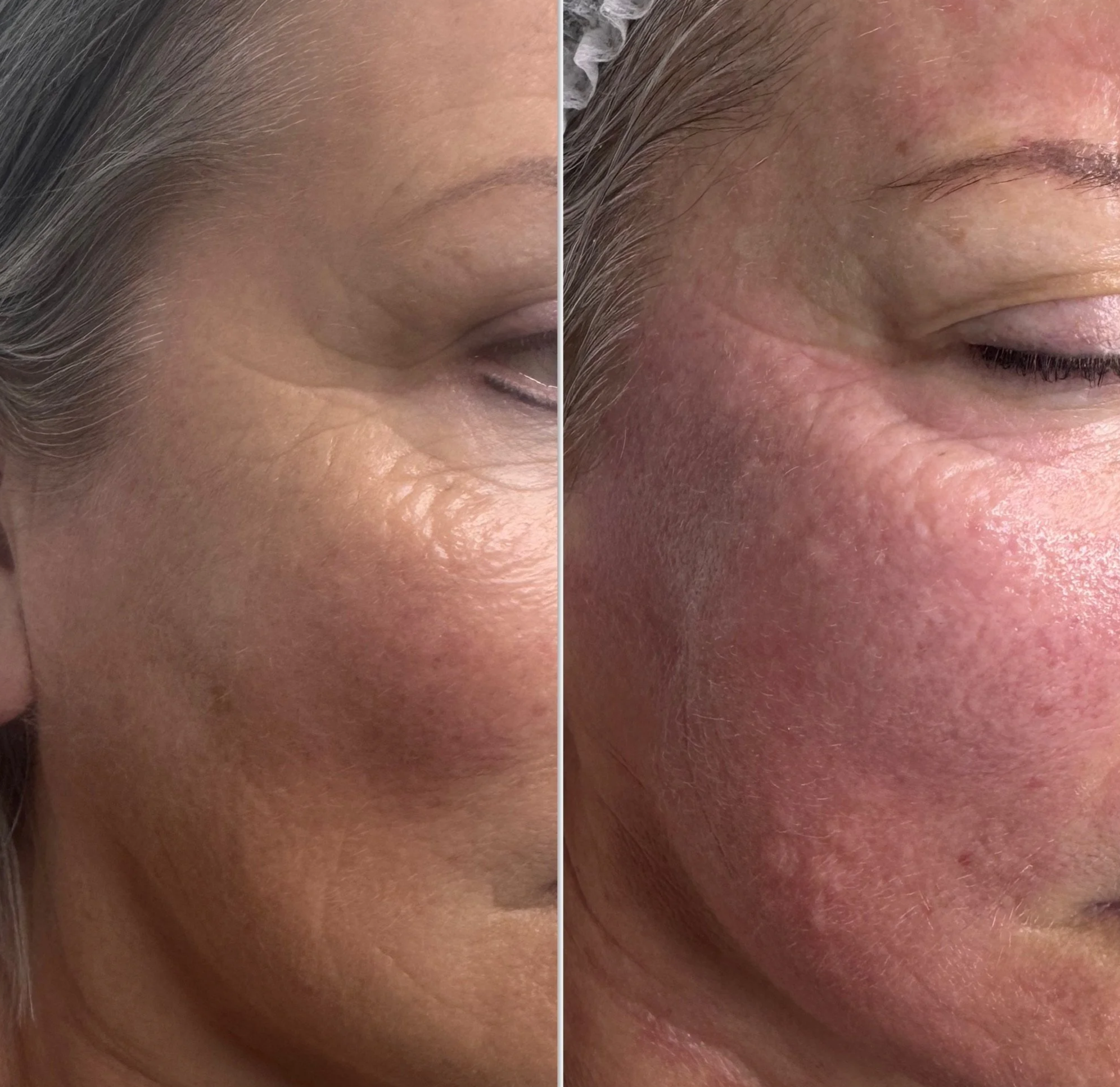 Close-up comparison of a person's cheek before and after skincare treatment, showing reduced redness and improved skin texture on the right.