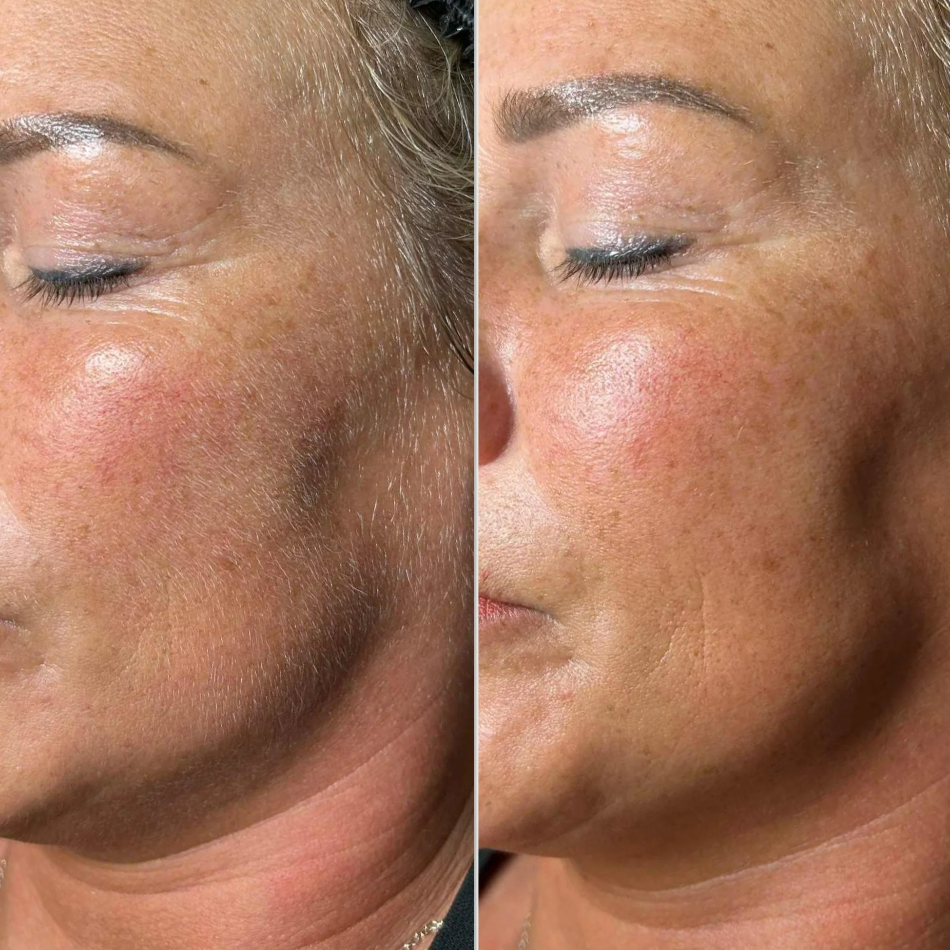 Close-up comparison of a woman's face showing skin before and after skincare treatment, with smoother, less pigmented skin on the right.