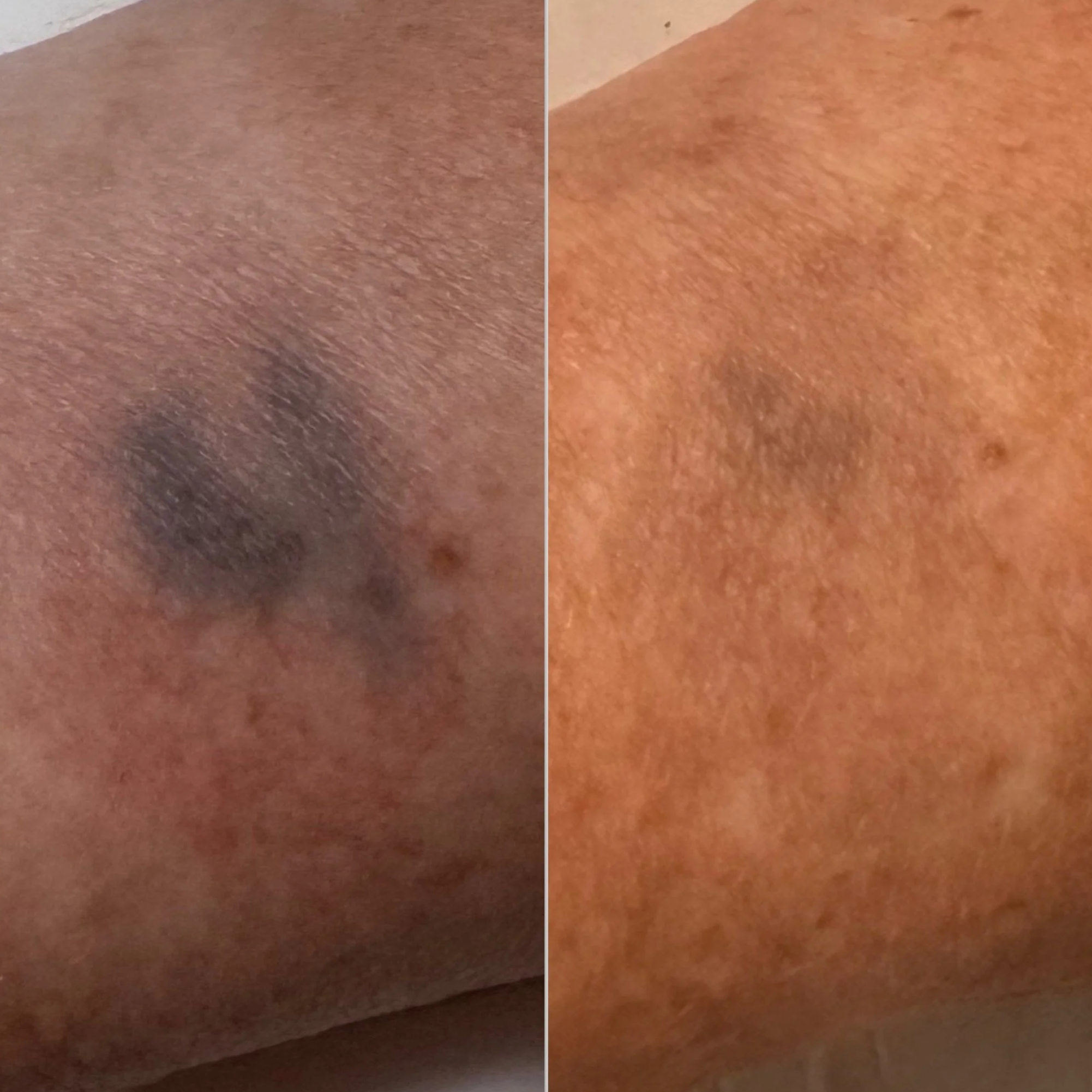 Close-up of skin showing a dark mole or blemish on the left, and clear skin on the right, indicating skin treatment or removal.