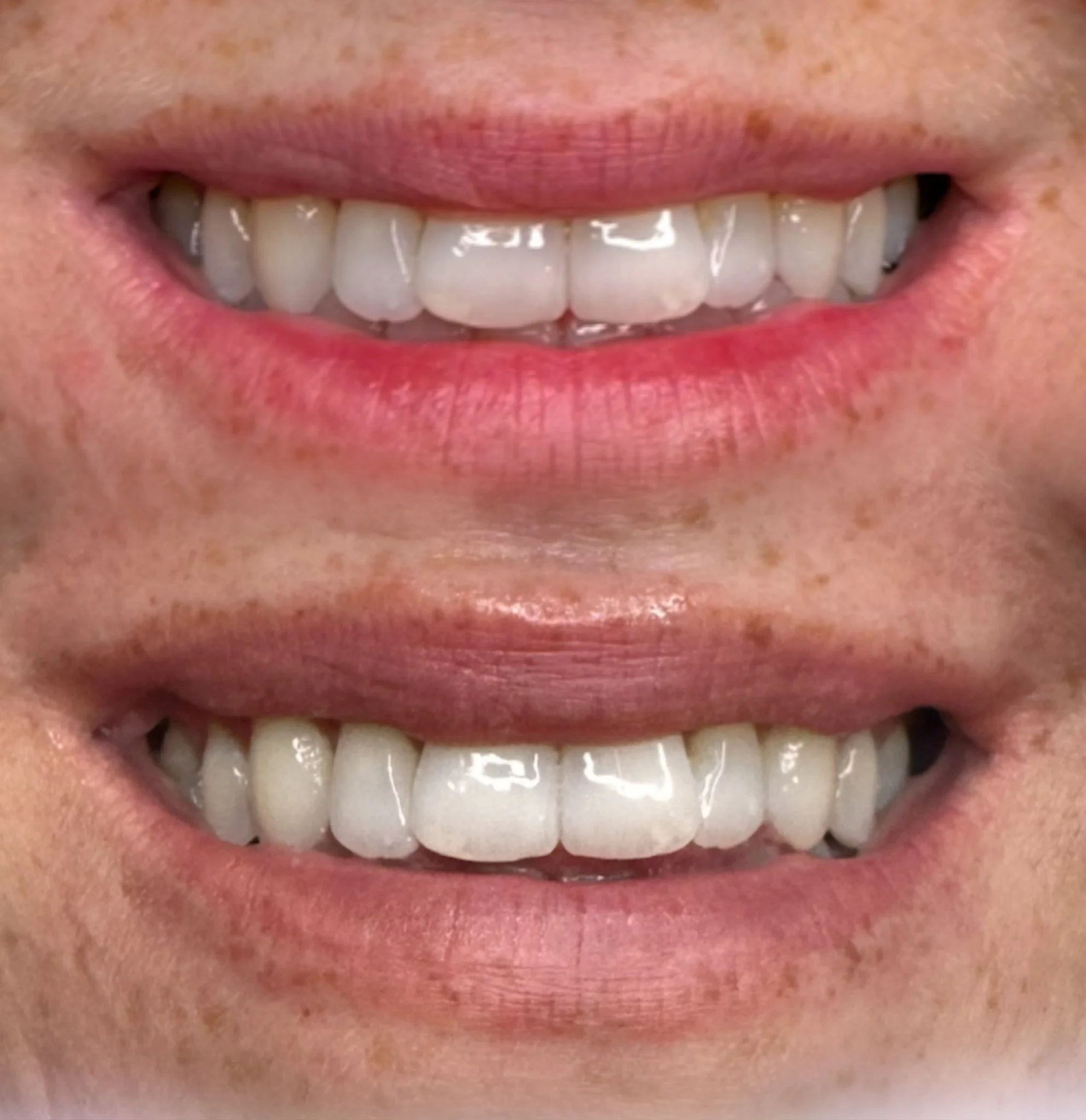 Close-up of a person's smile showing their teeth and pink lips.