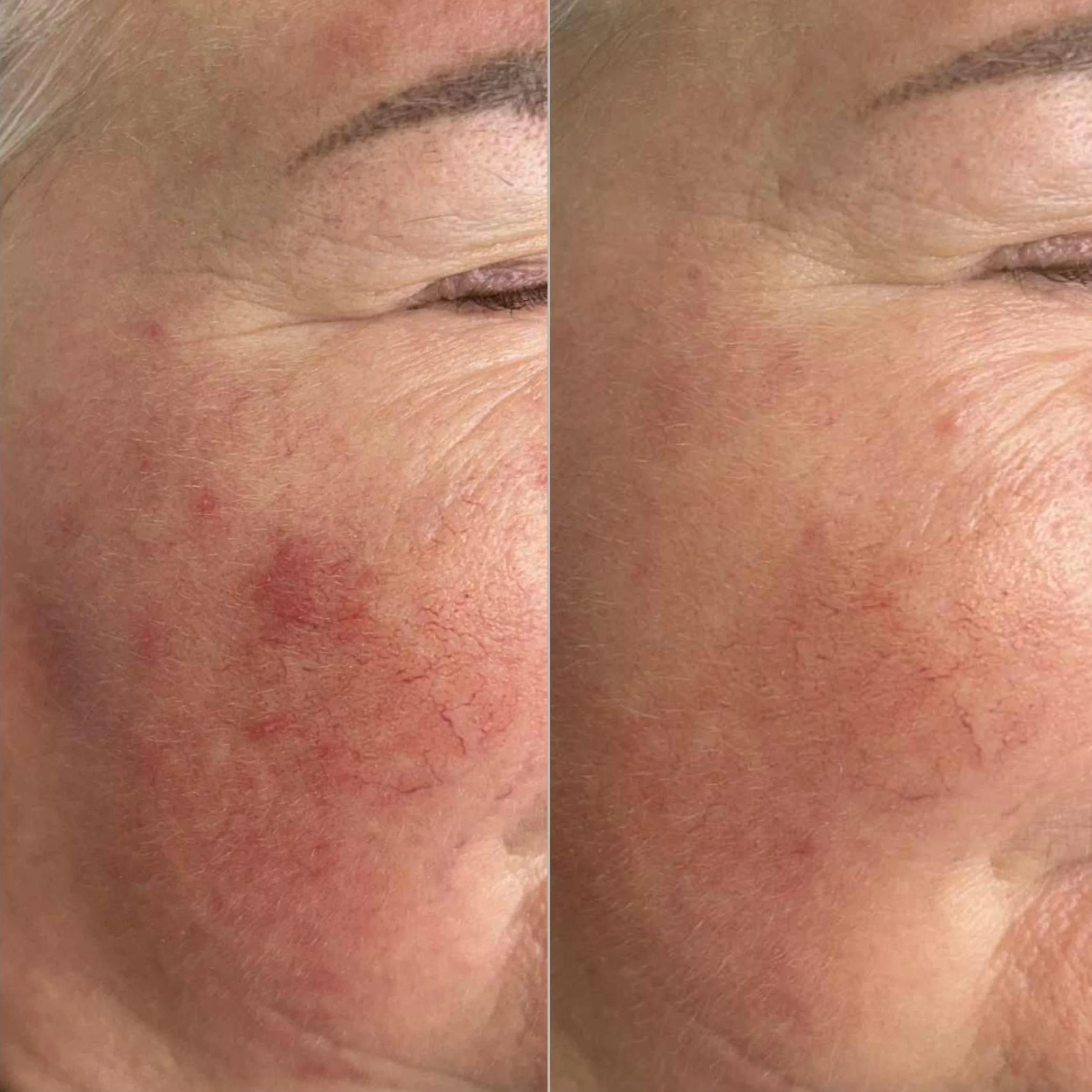 Close-up of a person's cheek before and after skincare treatment showing reduced redness and improved skin texture.
