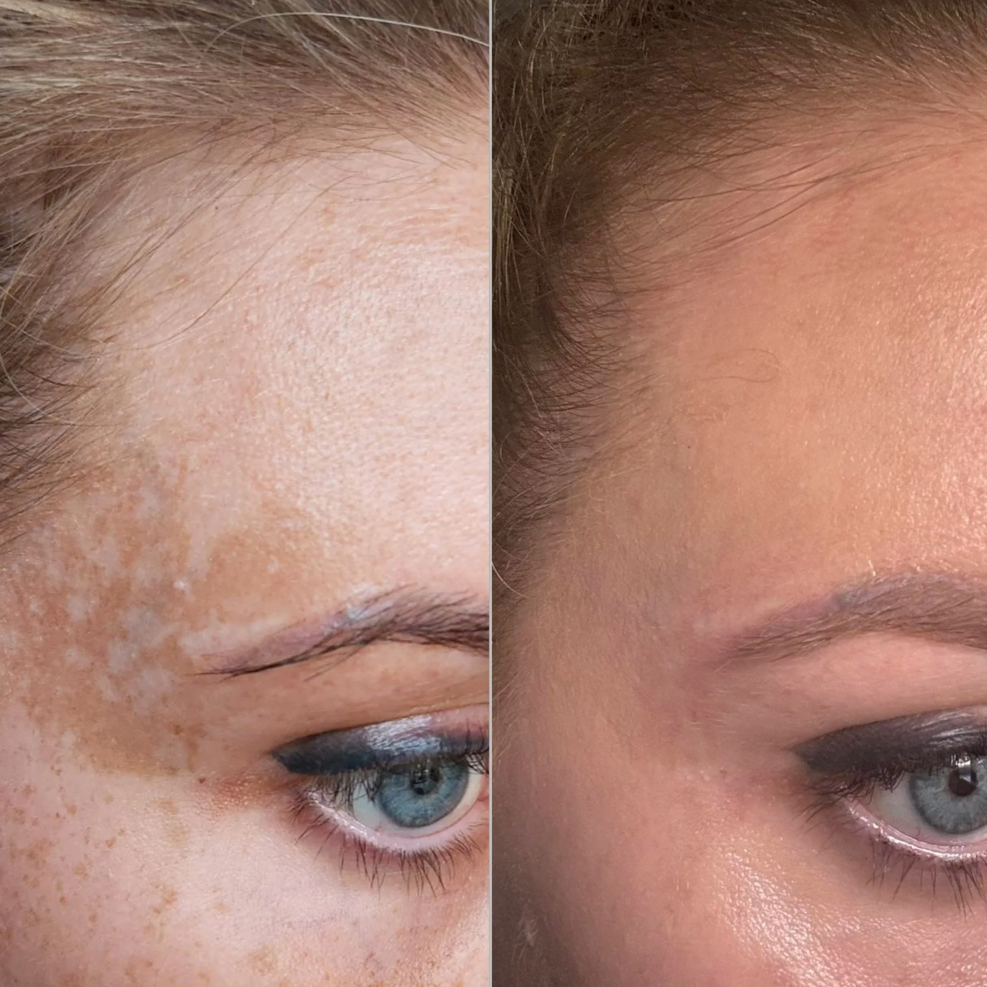 Side-by-side comparison of a woman's face before and after skincare, showing clearer skin with fewer spots on the right.