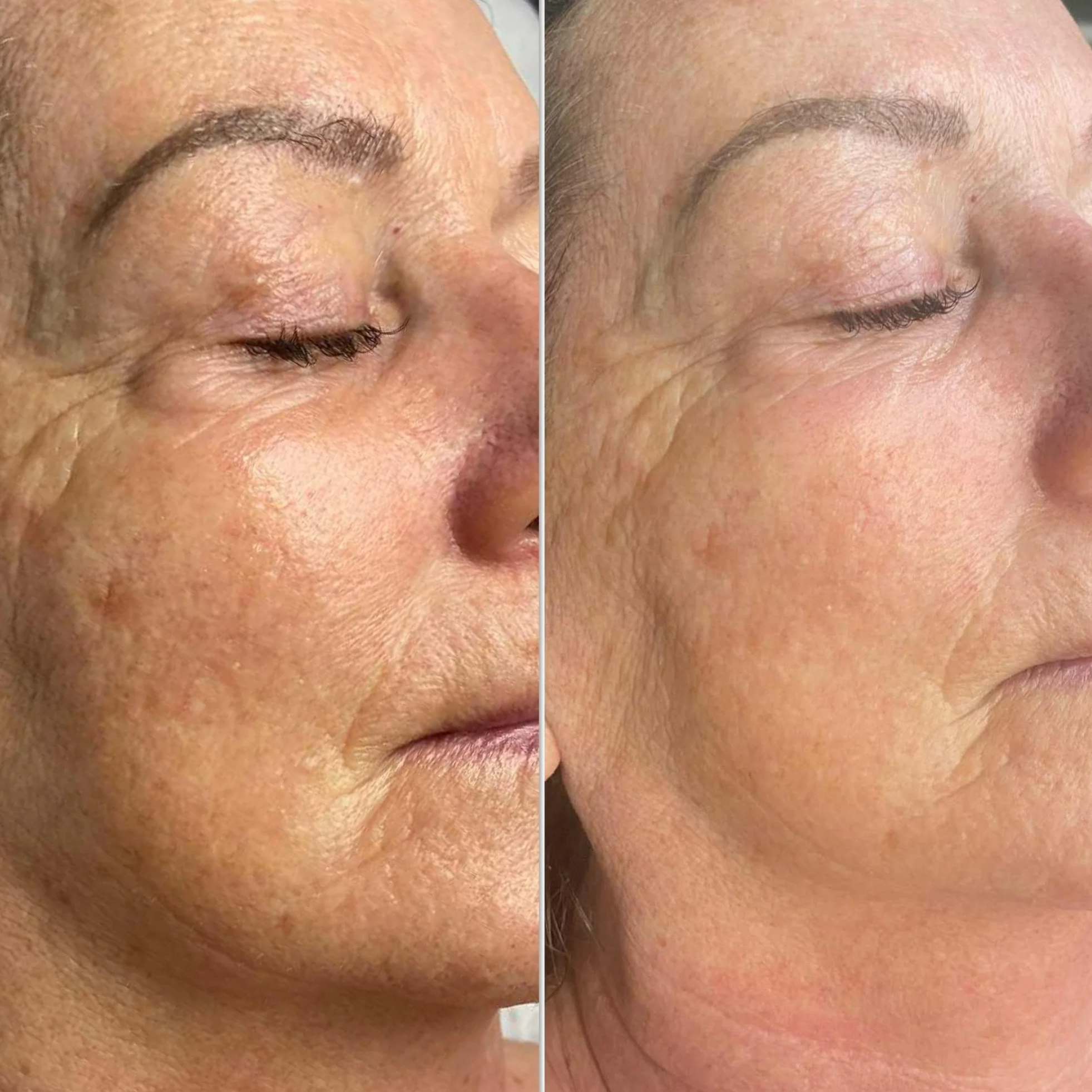 Side-by-side comparison of a woman's face showing improvement in skin texture and appearance, before and after skincare treatment.